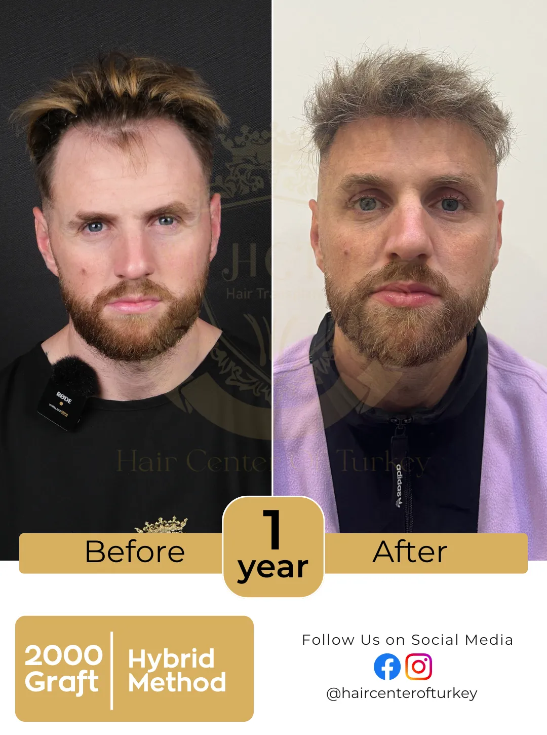 Hair Transplant Before And After