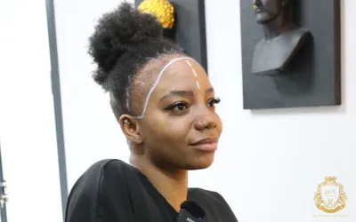 Hair Transplant for Black Females Near Me