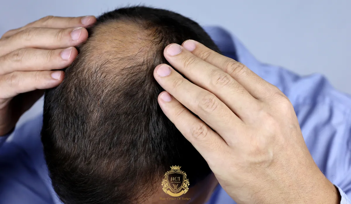 What Is The Best Age To Get A Hair Transplant