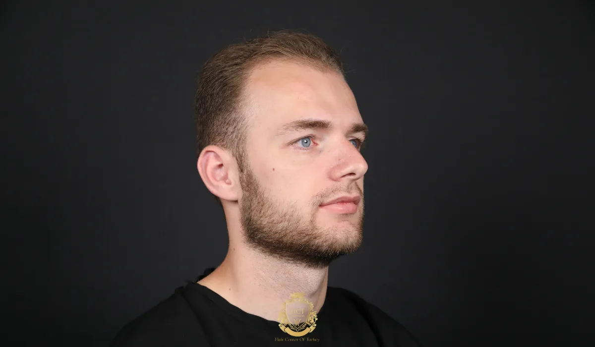 What Is The Best Age To Get A Hair Transplant