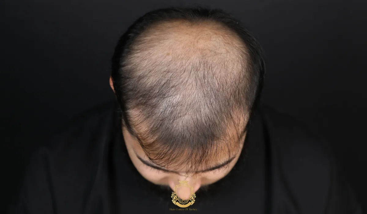 What Is The Best Age To Get A Hair Transplant