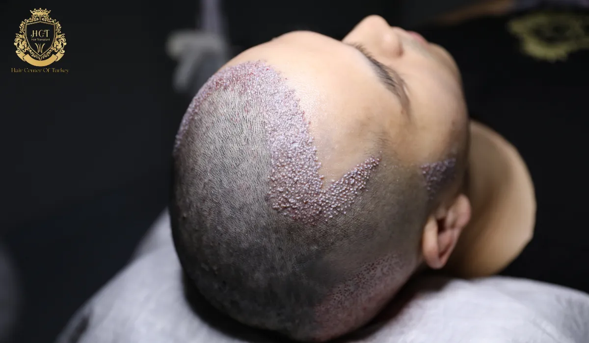 Mens Hair Transplant Near Me