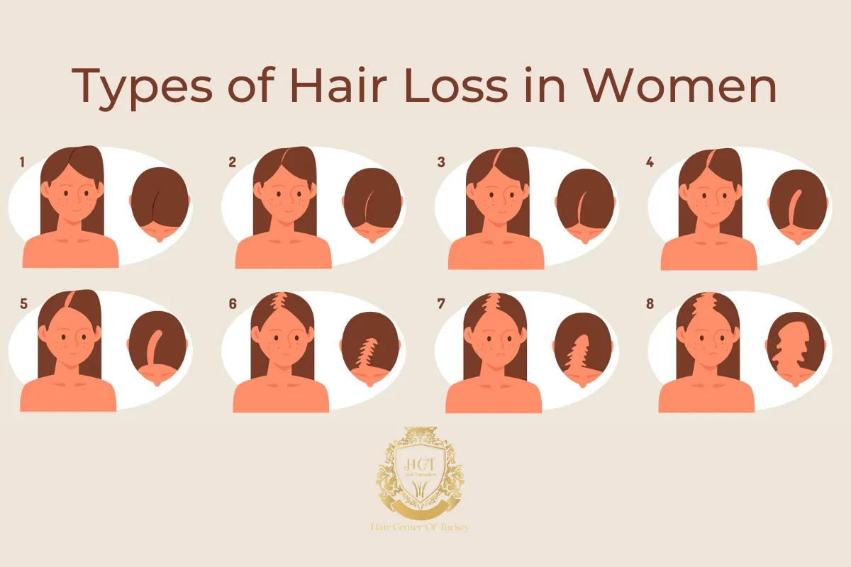 Types of Hair Loss in Women