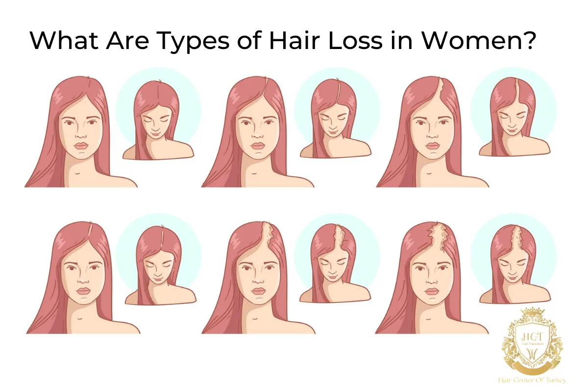 Types of Hair Loss in Women