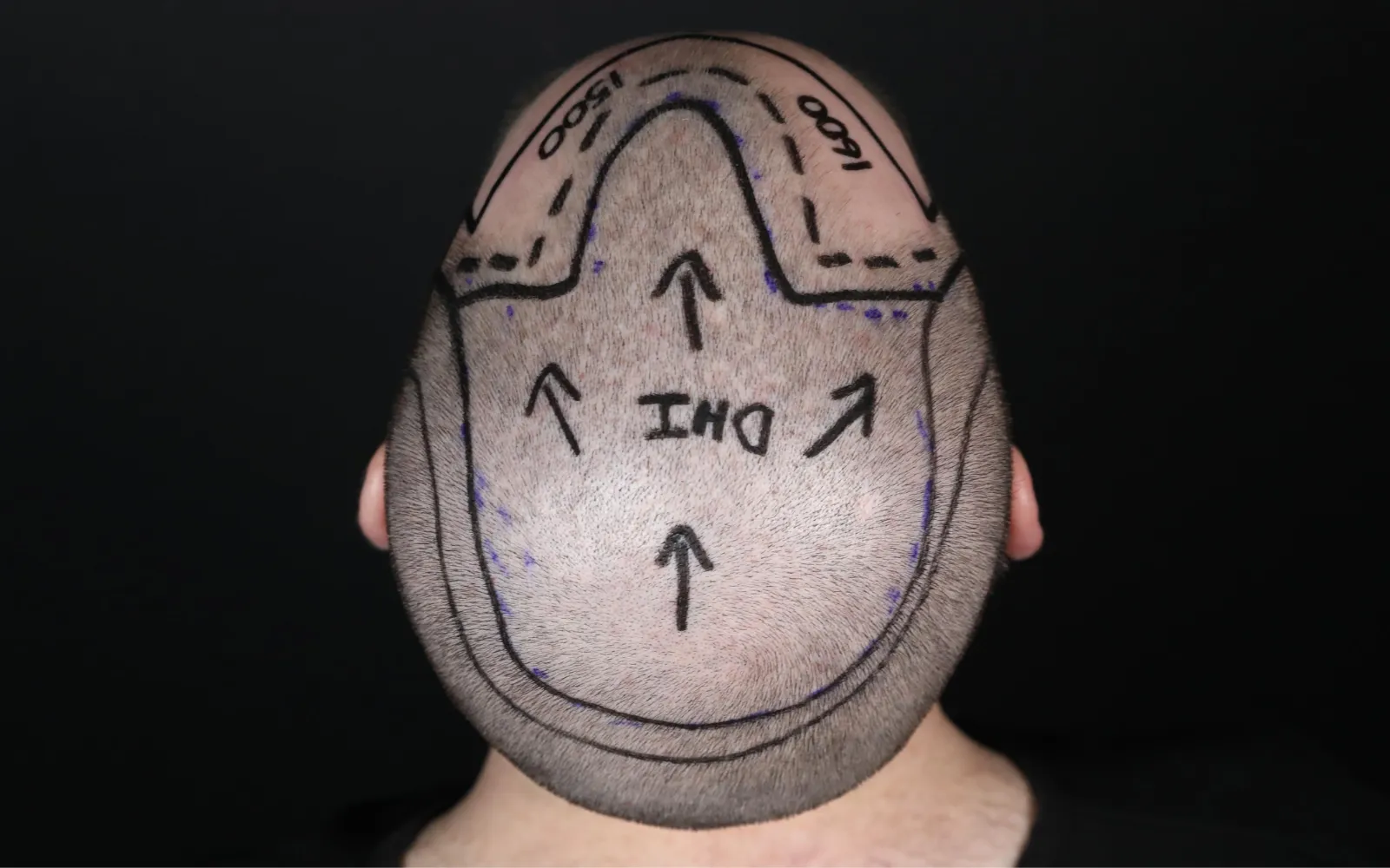 dhi hair transplant prices