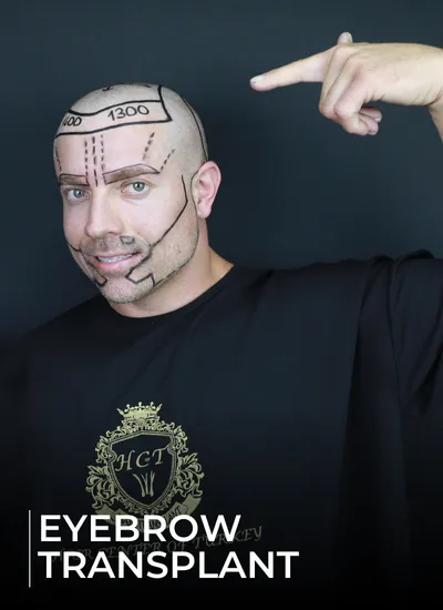 eyebrow transplant categories