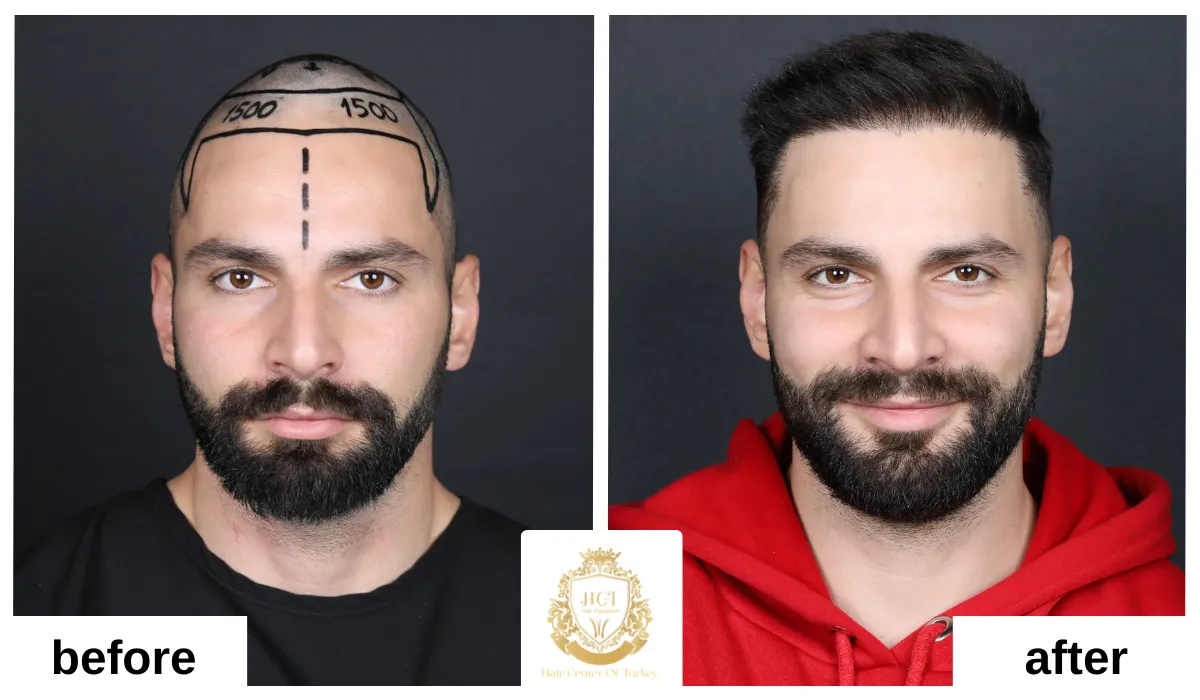 fue hair transplant before and after