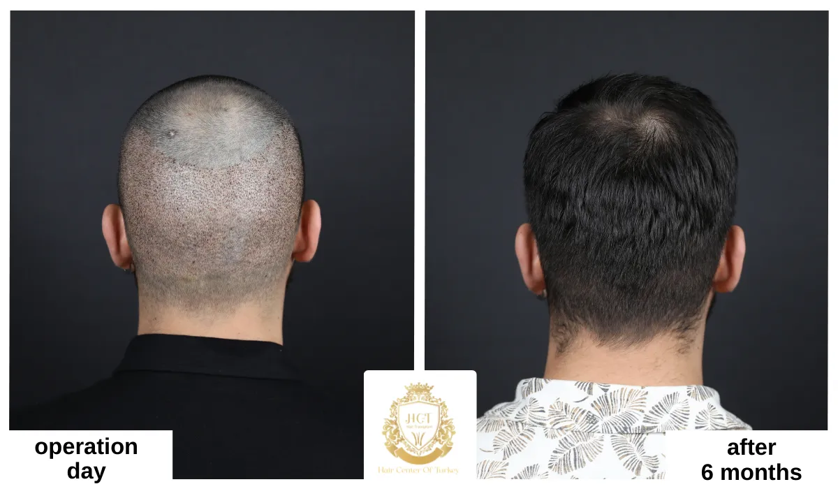 fue hair transplant recovery