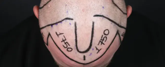 how much is 3500 grafts hair transplant