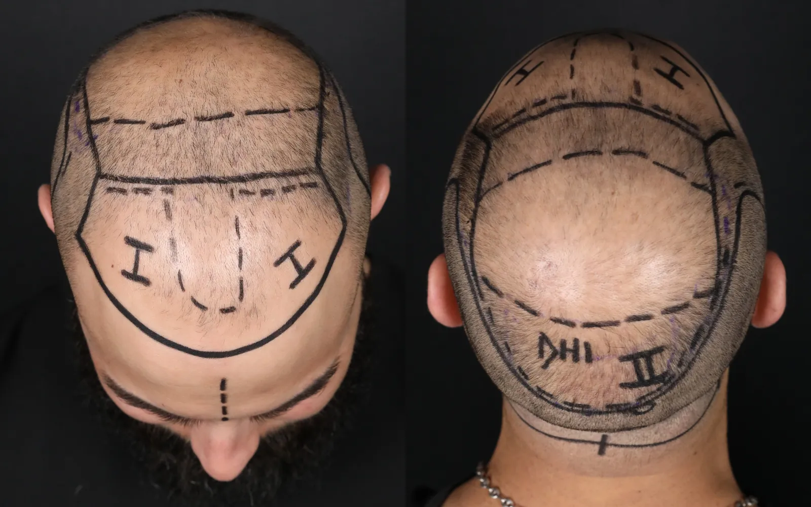 hybrid hair transplant prices