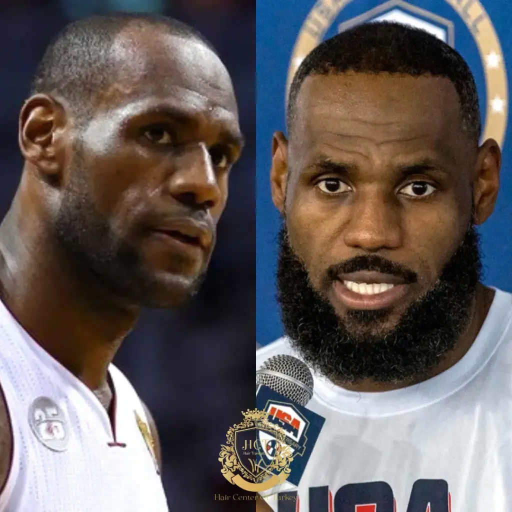 lebron james hair transplant