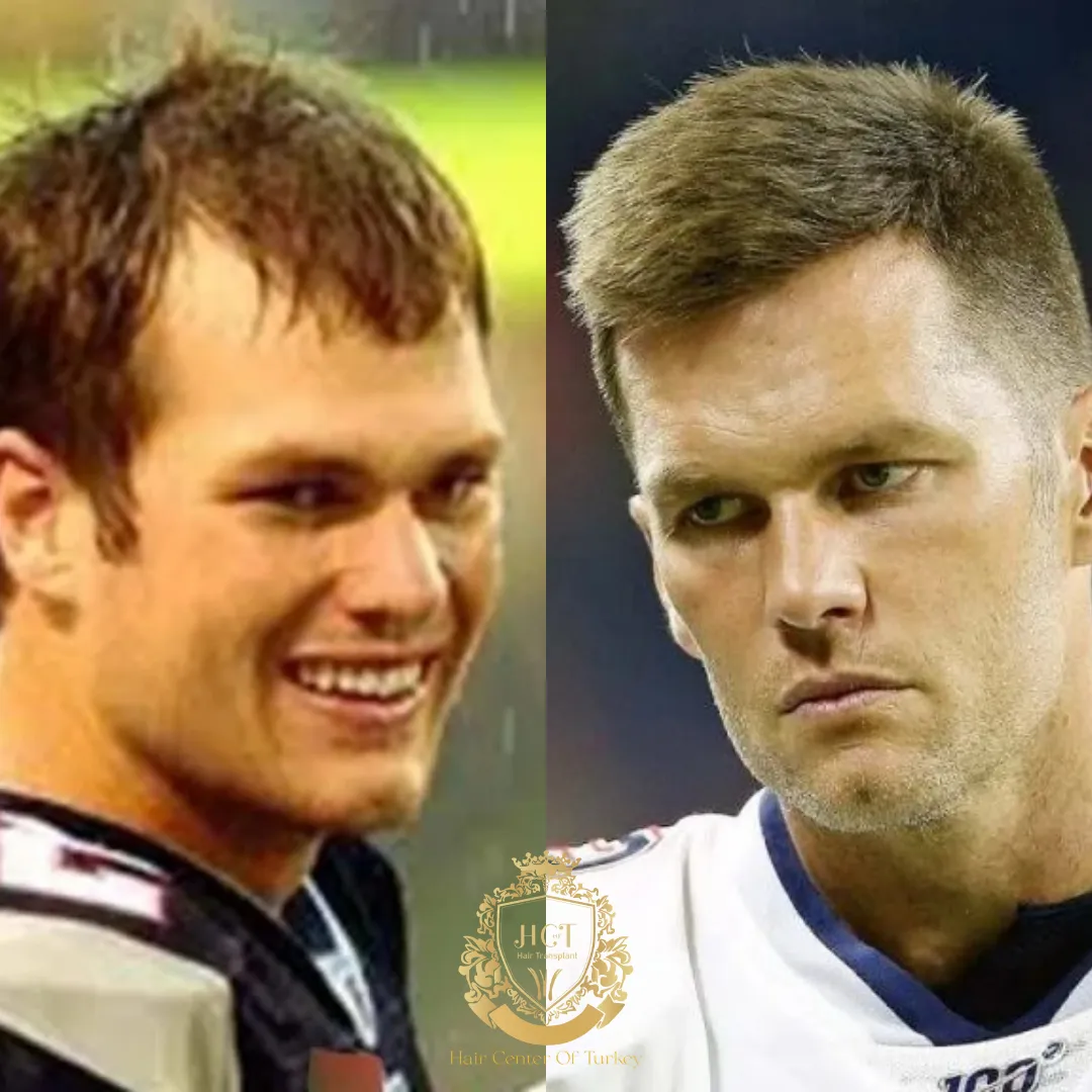 tom brady hair transplant featured image 1