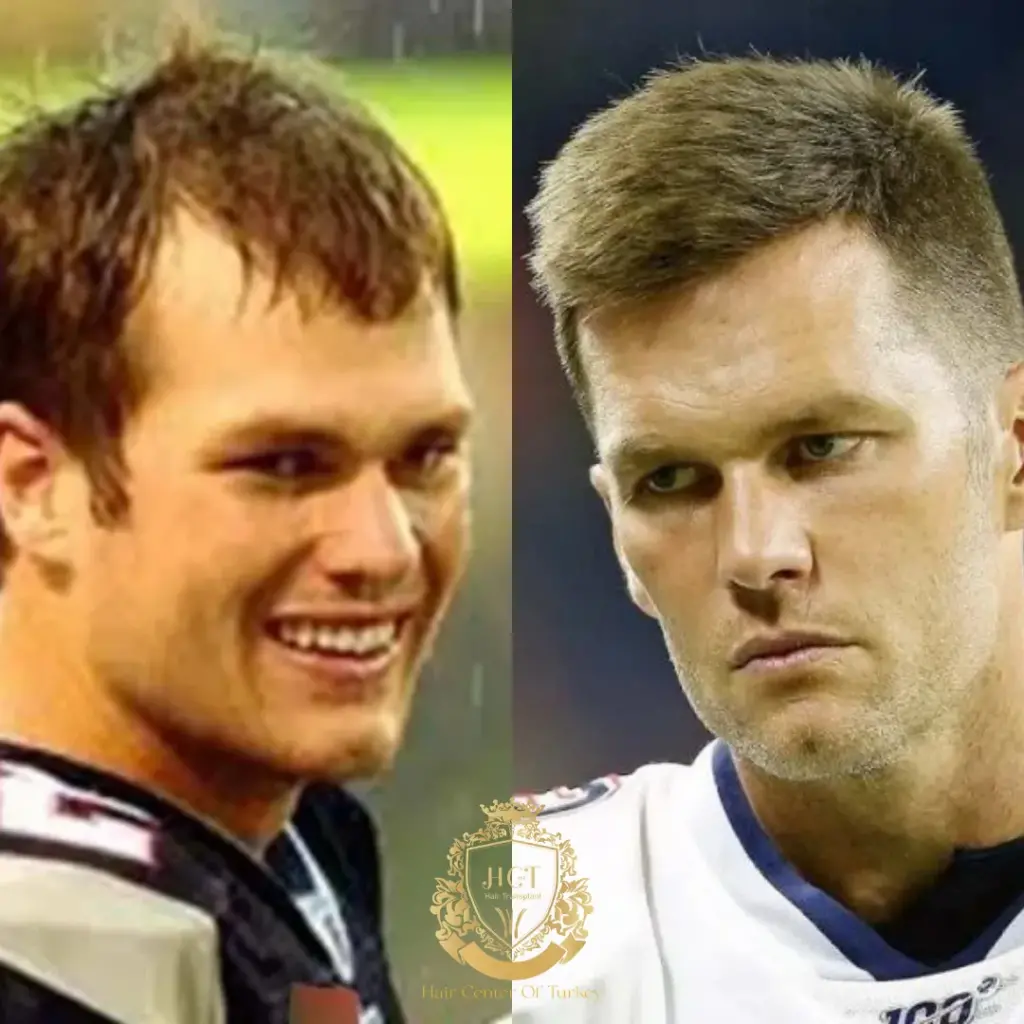 tom brady hair transplant