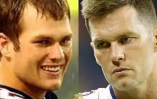 tom brady hair transplant