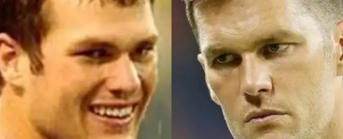 tom brady hair transplant