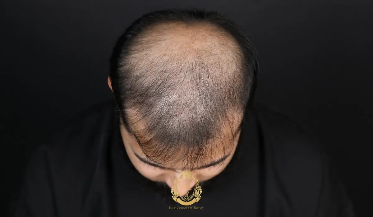 vertex hill area hair transplant