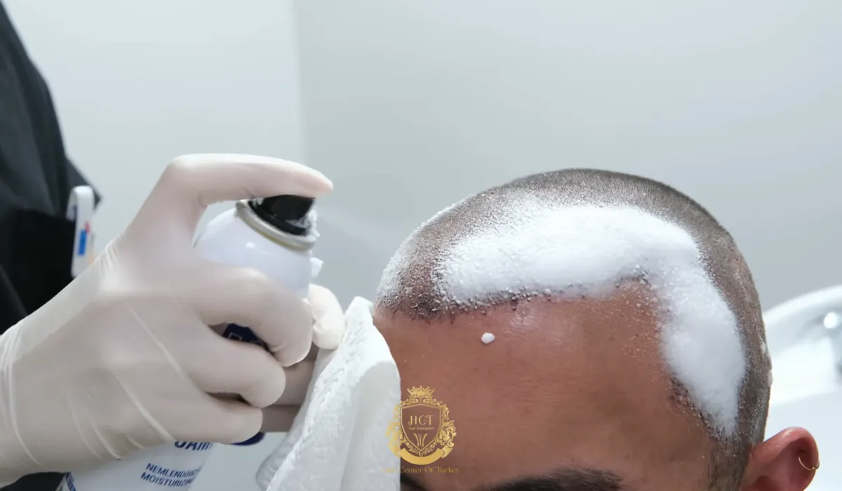 vertex hill area hair transplant