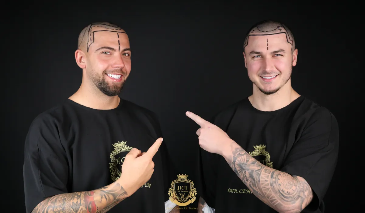 why choose turkey for hair transplant