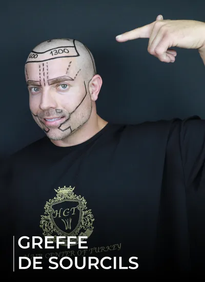 GREFFE DE SOURCILS