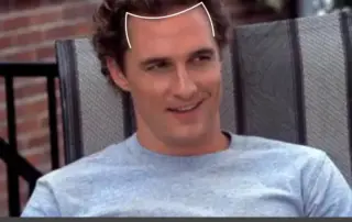 Matthew McConaughey Hair Transplant