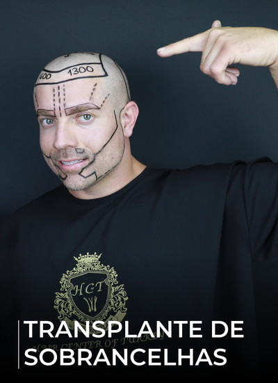 TRANSPLANTE DE SOBRANCELHAS