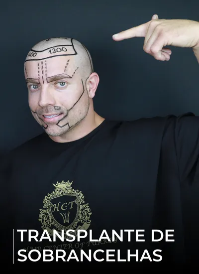 TRANSPLANTE DE SOBRANCELHAS