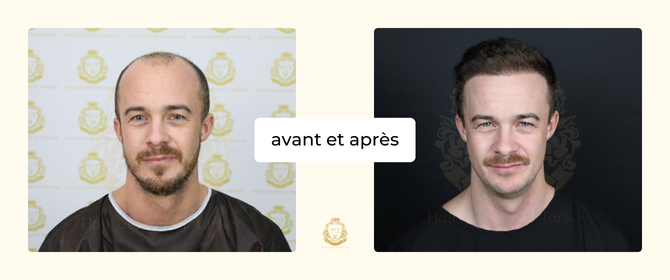 best hair transplant clinics 2