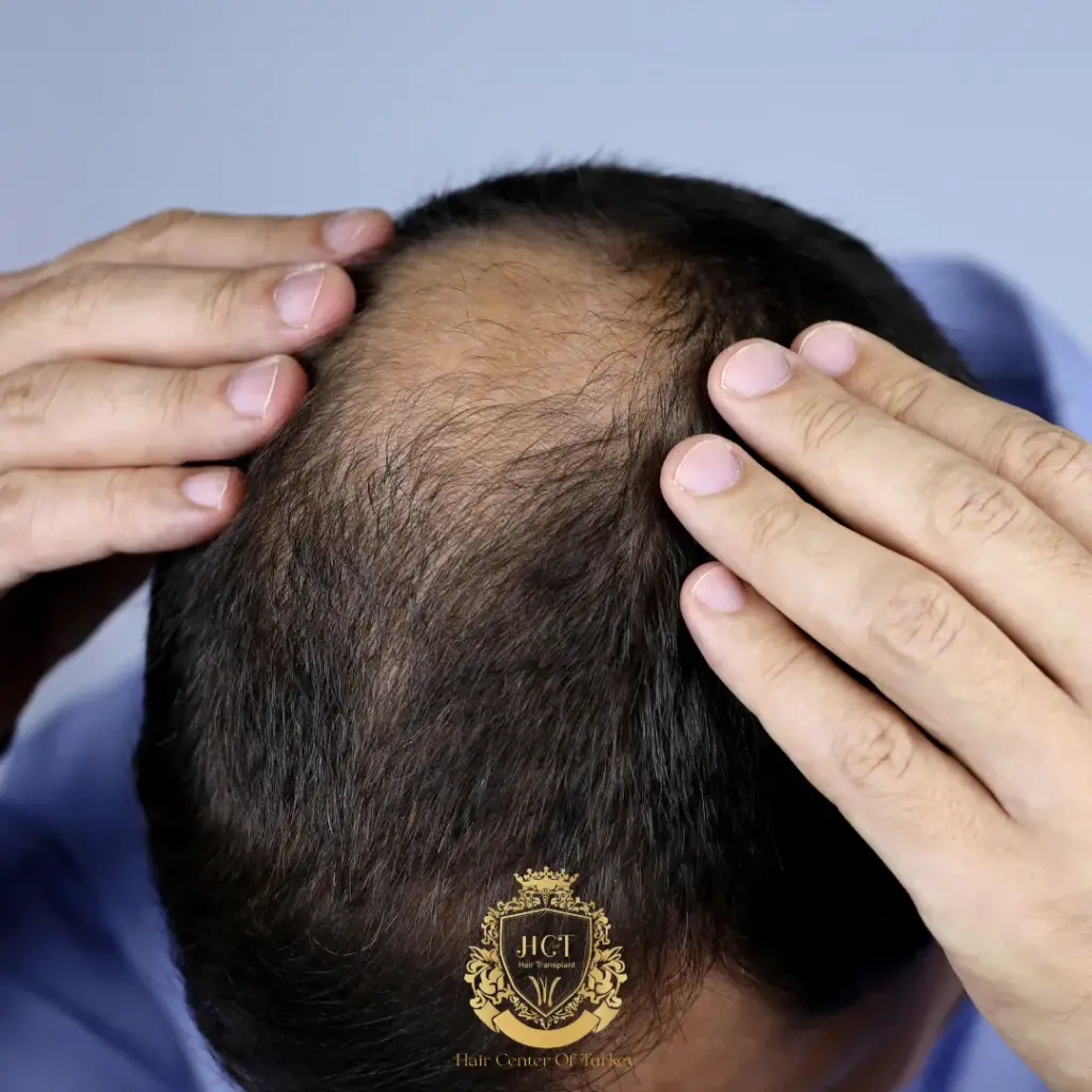 can hair grow back after balding