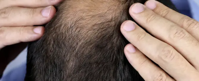 can hair grow back after balding