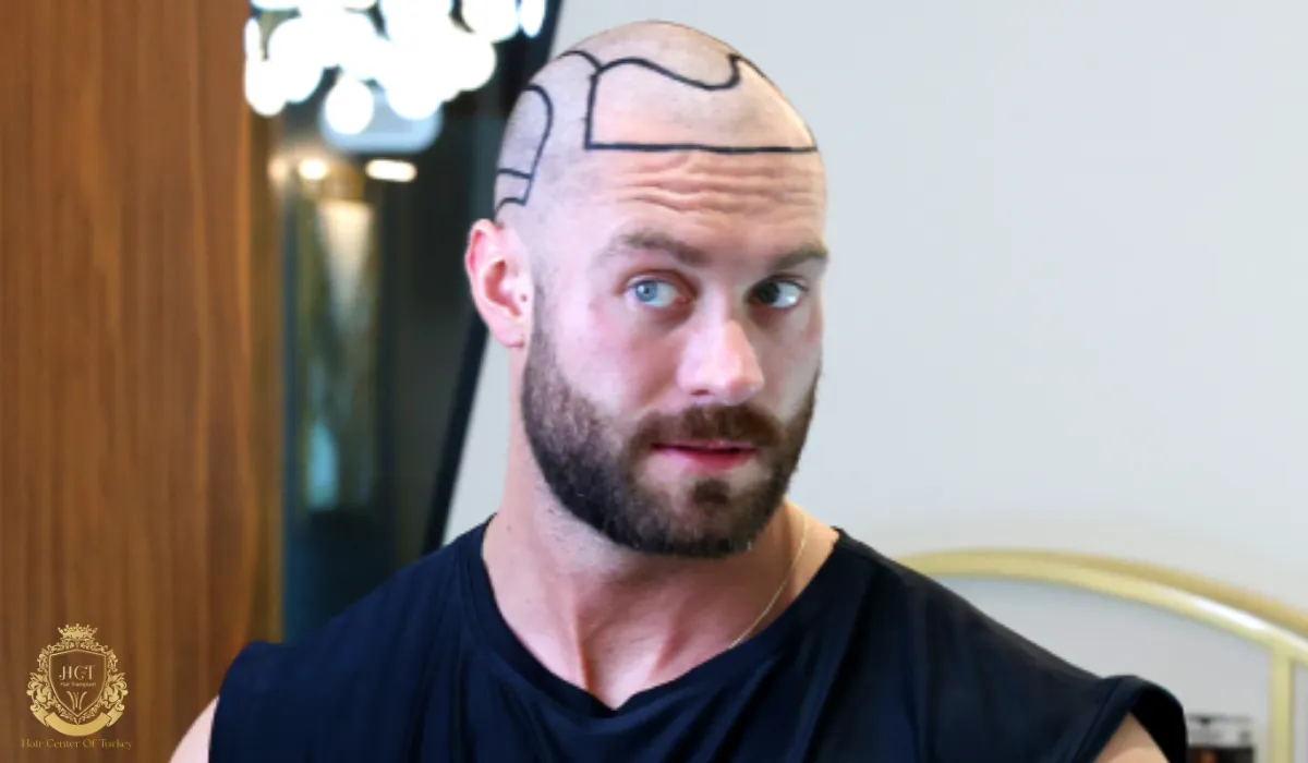 chris bumstead hair transplant