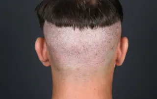 hair transplant scar