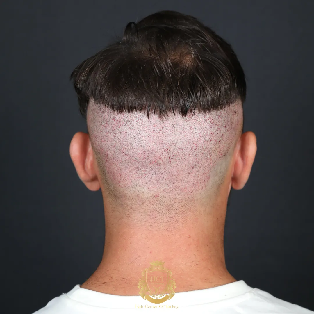 hair transplant scar