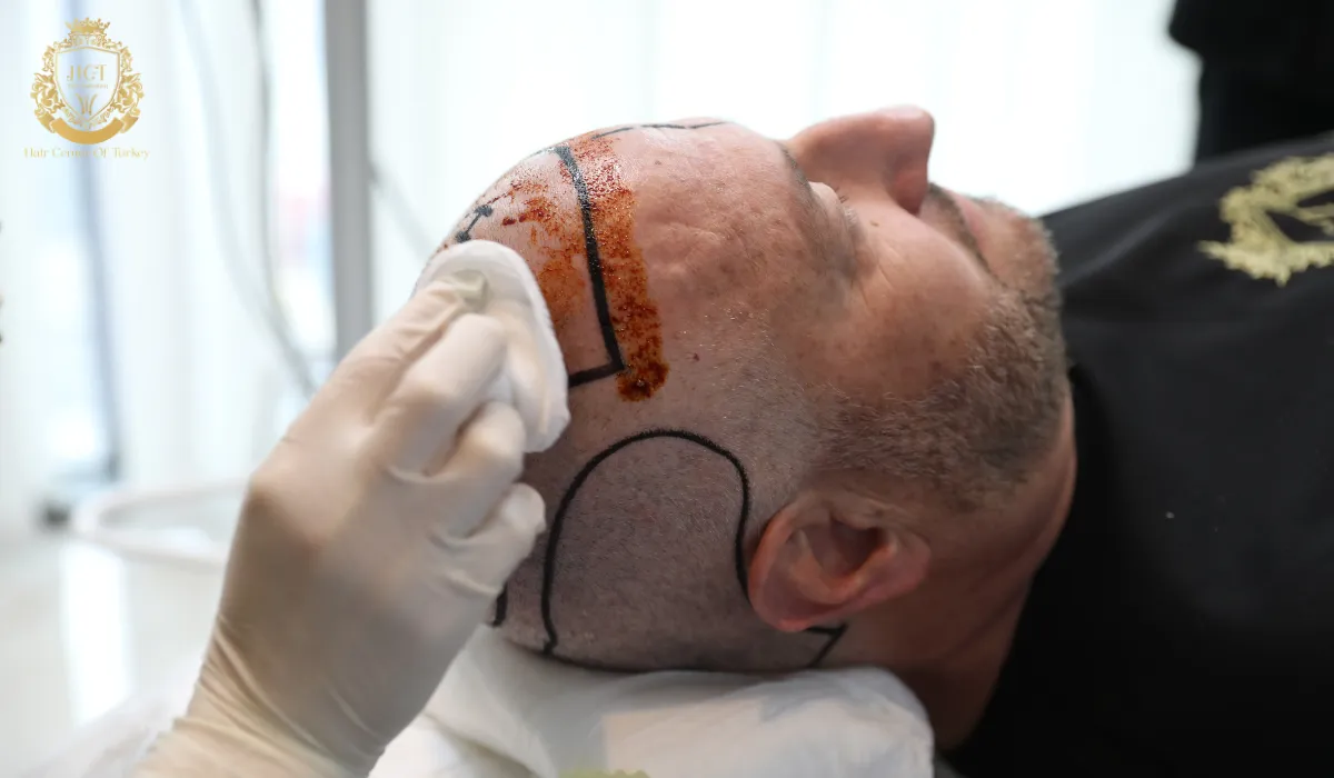 hair transplant with sedation 