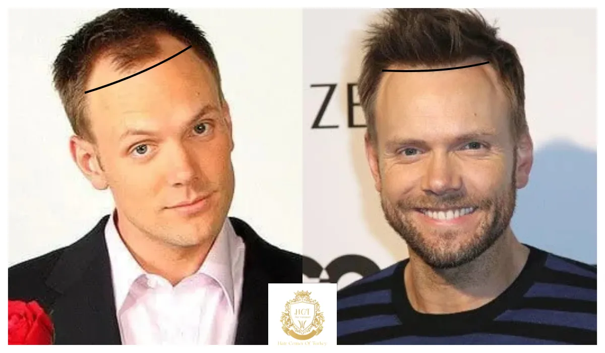 joel mchale hair transplant