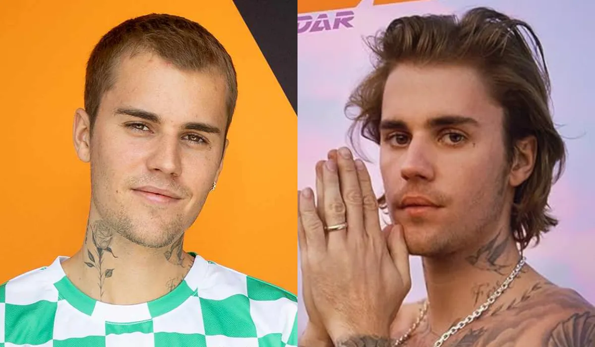 justin bieber hair transplant