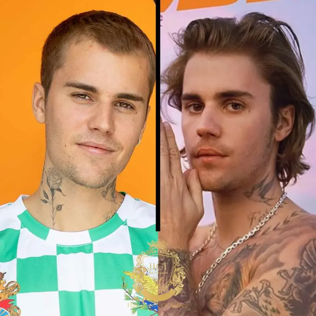 justin bieber hair transplant