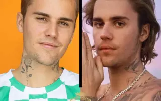 justin bieber hair transplant