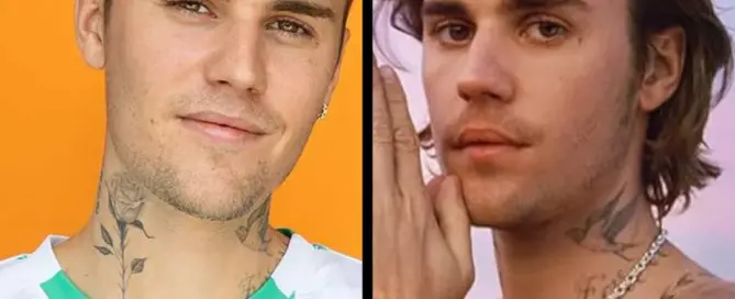 justin bieber hair transplant