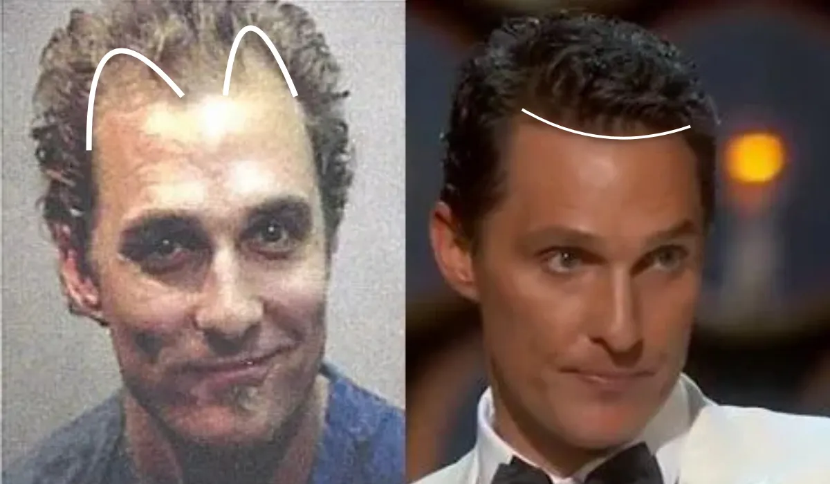 matthew mconaughey hair transplant