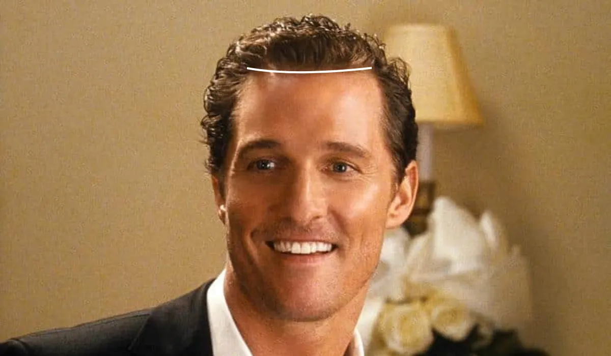 matthew mconaughey hair transplant