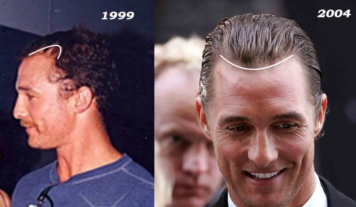 matthew mconaughey hair transplant