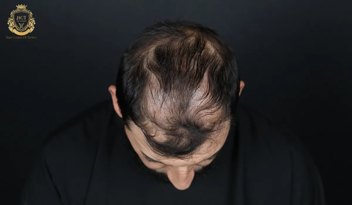 receding hairline