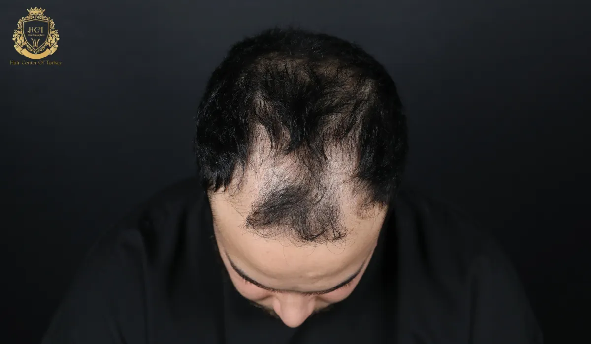 receding hairline