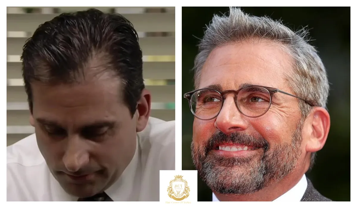 steve carell hair transplant