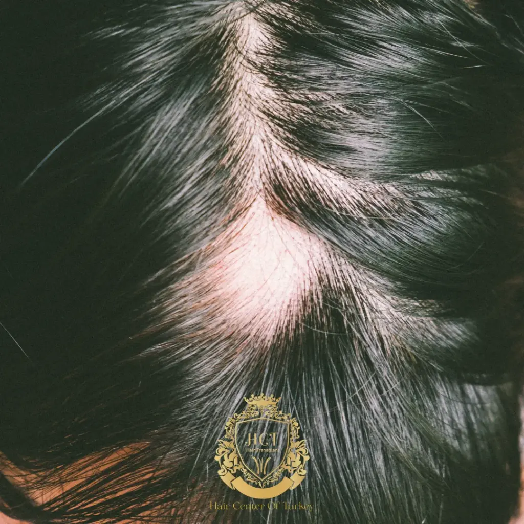 traction alopecia