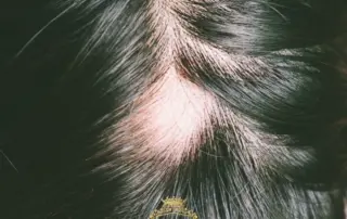 traction alopecia