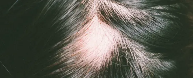 traction alopecia