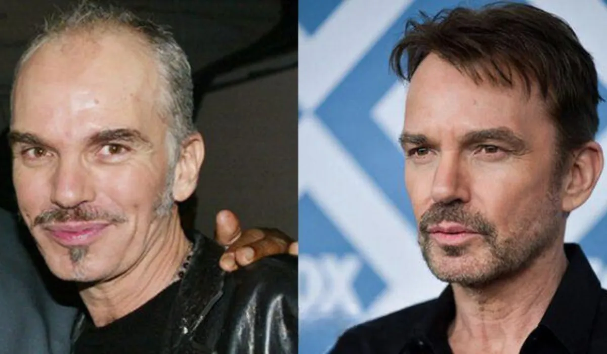 Billy Bob Thornton Hair Transplant 