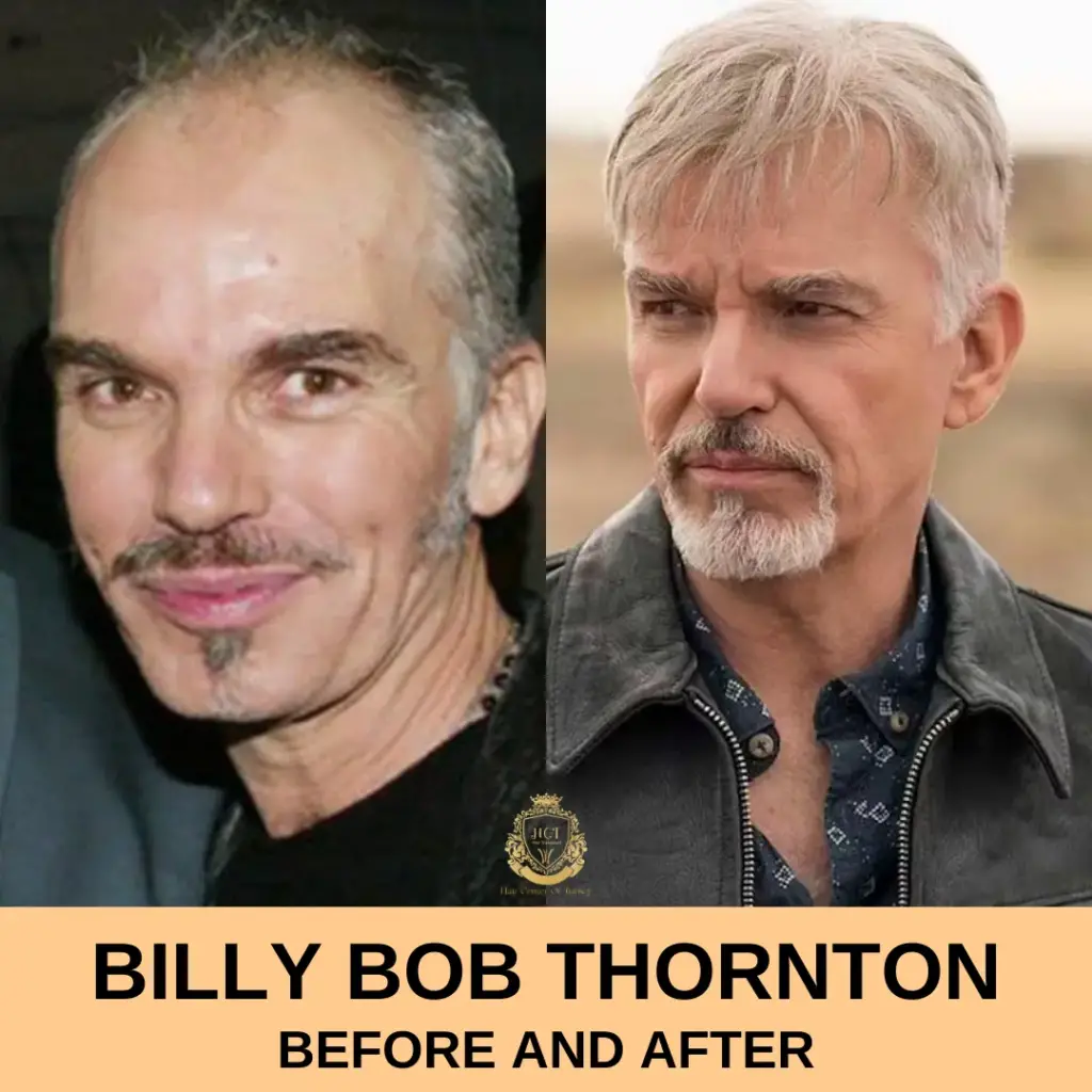 Billy Bob Thornton Hair Transplant