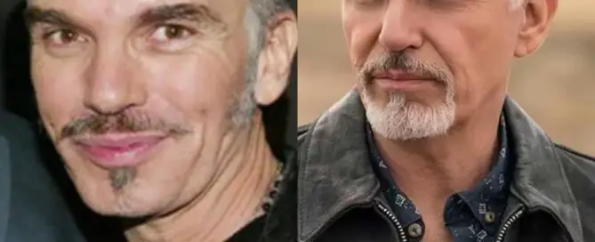 Billy Bob Thornton Hair Transplant